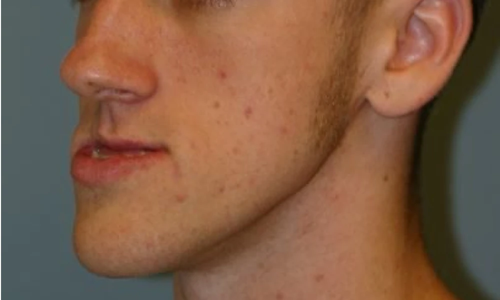 Clinical photo from Joe's corrective jaw surgery case